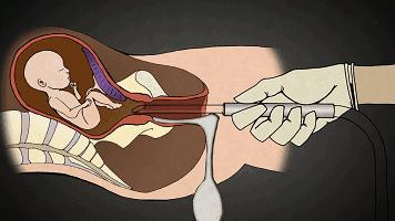 无痛人流是真的一点感觉都没有吗,无痛人流安全吗会不会造成不孕