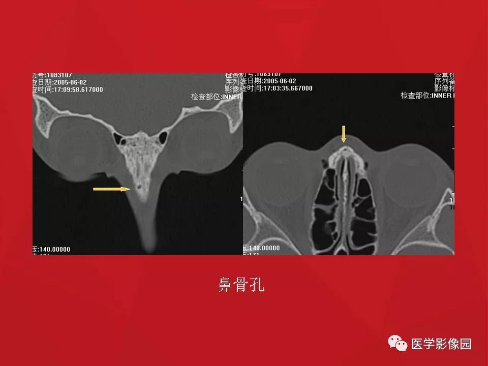 左侧鼻骨骨折伴鼻中隔骨折,双侧鼻骨及左上颌骨突骨折