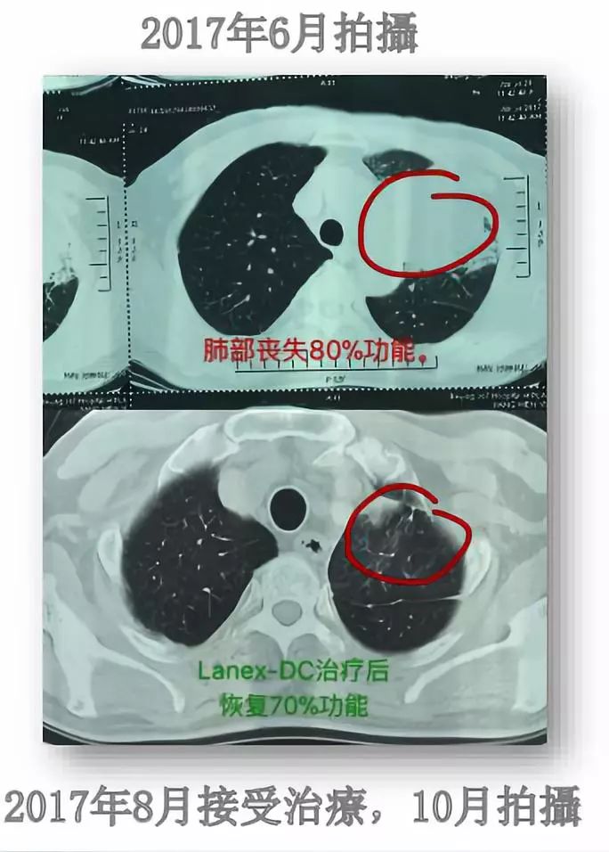 肿瘤细胞免疫治疗是什么,细胞免疫治疗视频大全