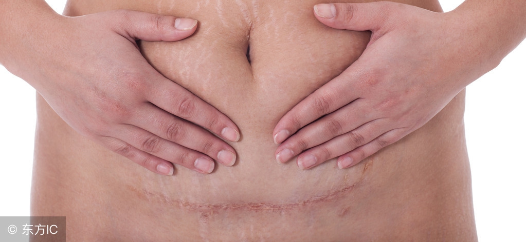 第一胎剖腹产第二胎需要注意什么,剖腹产怀孕晚期都要注意啥