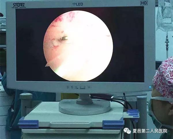 妇科微创内窥镜之宫腔镜——“洞若观火，斩妖除魔”