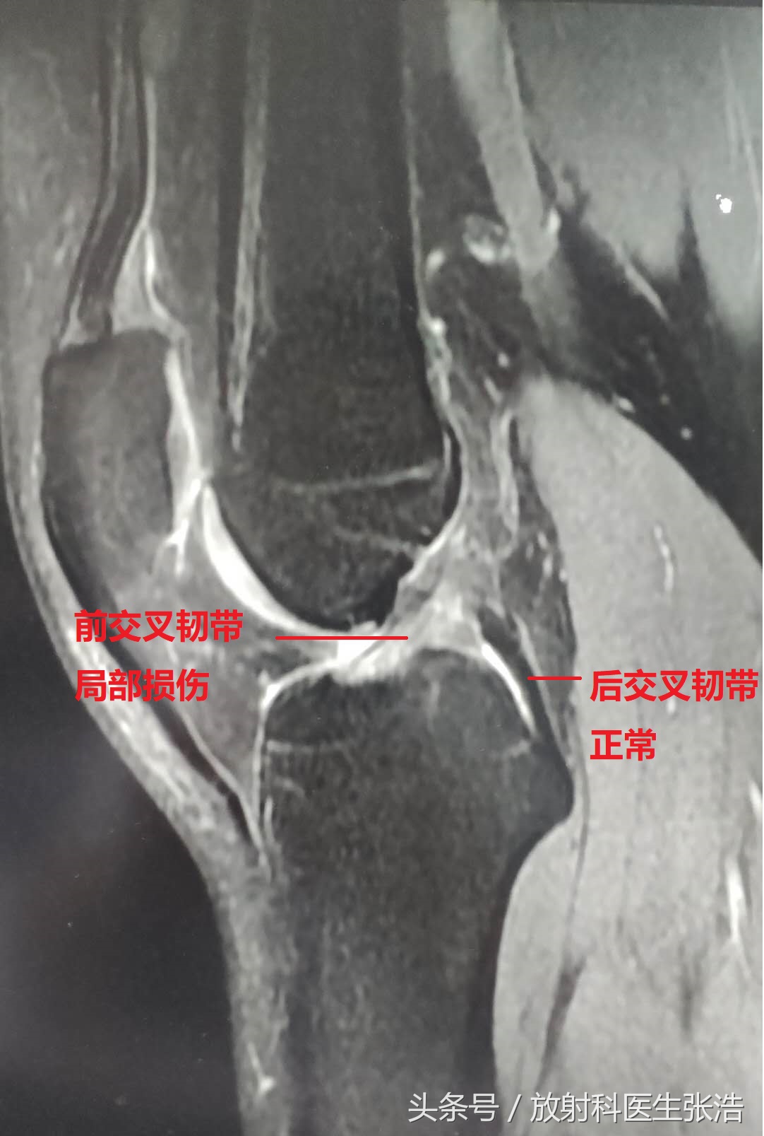 膝关节疼照x光片有用吗,膝关节疼痛x光片能看出来吗