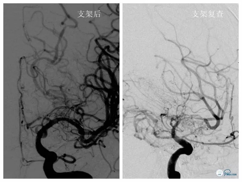 大脑中动脉支架术后再狭窄的几率,天坛医院介入脑血管手术