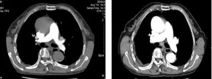 肺癌合并肺纤维化治疗,肺栓塞患者合并肺癌