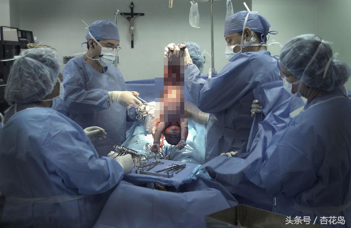 流产后剖宫产的风险,剖宫产做人流有风险吗