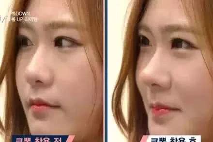 不动手术有哪些隆鼻方法,不动刀的隆鼻好方法