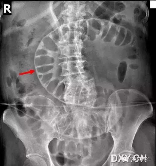 10种经典肠道影像征象详解