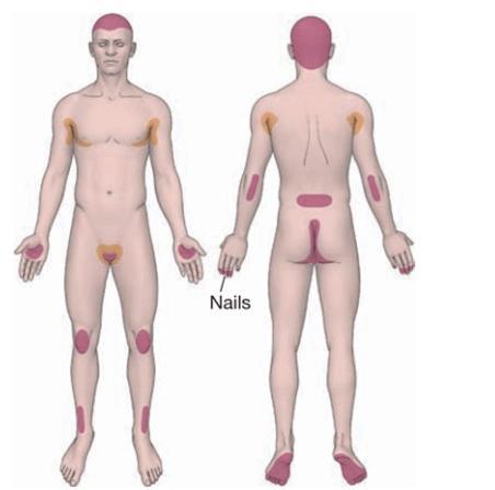 牛皮癣是严重疾病吗,牛皮癣属于什么类疾病