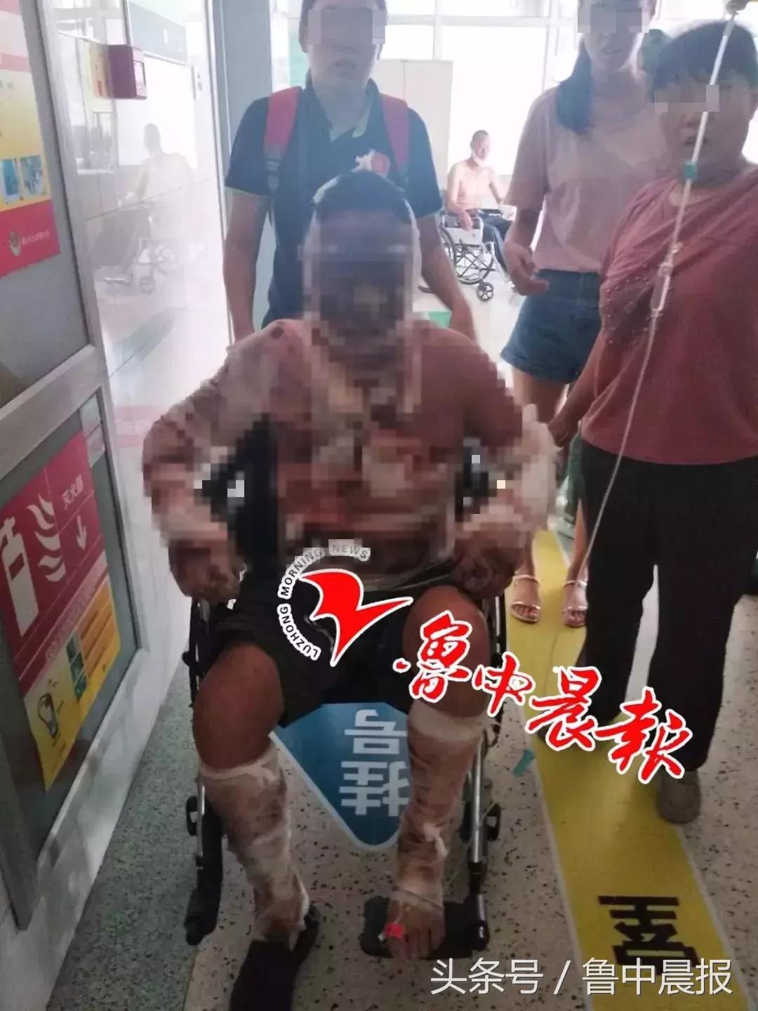 吓人！淄博一男子被严重烧伤！家人用这种方法治疗，差点出大事！