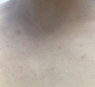 多年湿疹不用怕，简单1个小方法为你解决困扰，从今以后轻松愉快