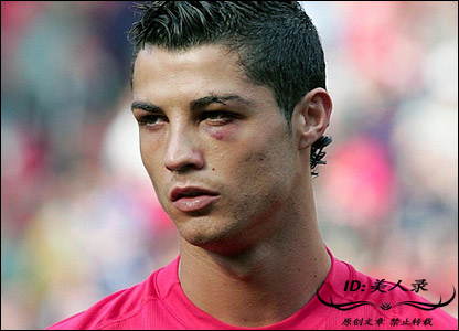 c罗被打满脸是血是哪一次,眼角被撞出血了一定要缝针么