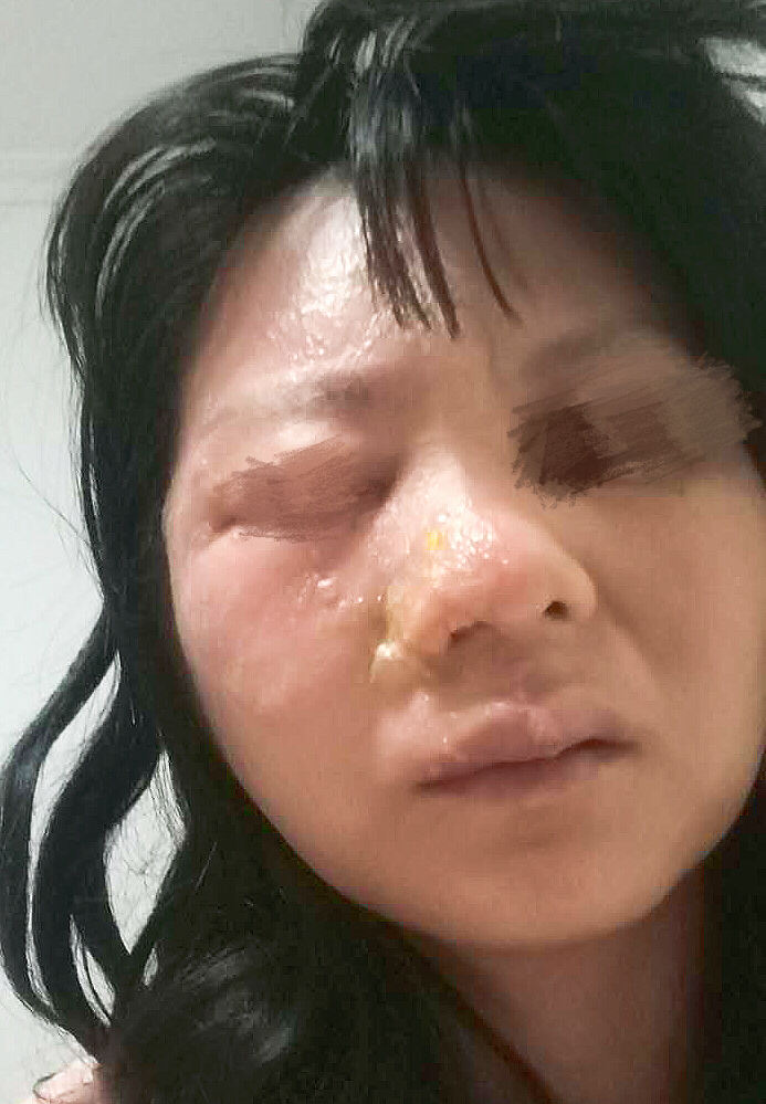 哺乳期妈妈得了带状疱疹,哺乳期带状疱疹会不会传染给孩子