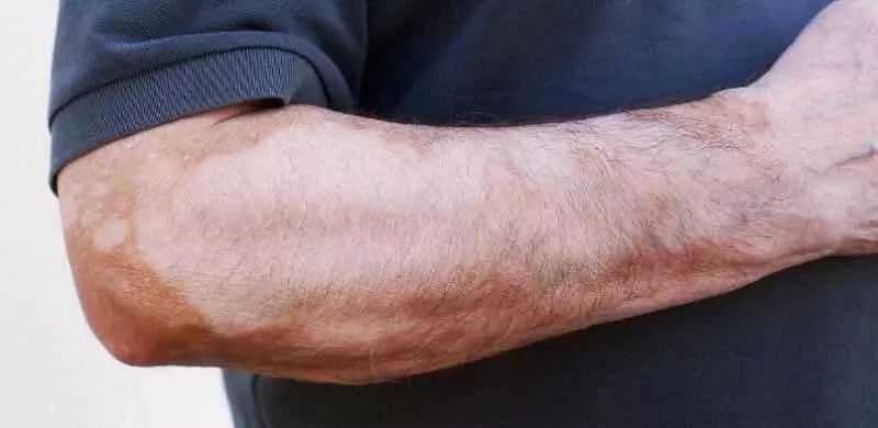 白癜风直播现场,白癜风治疗效果不明显