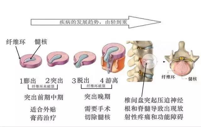 腰间盘突出：针对夏季的康复锻炼，坚持一个月，养出好腰椎！