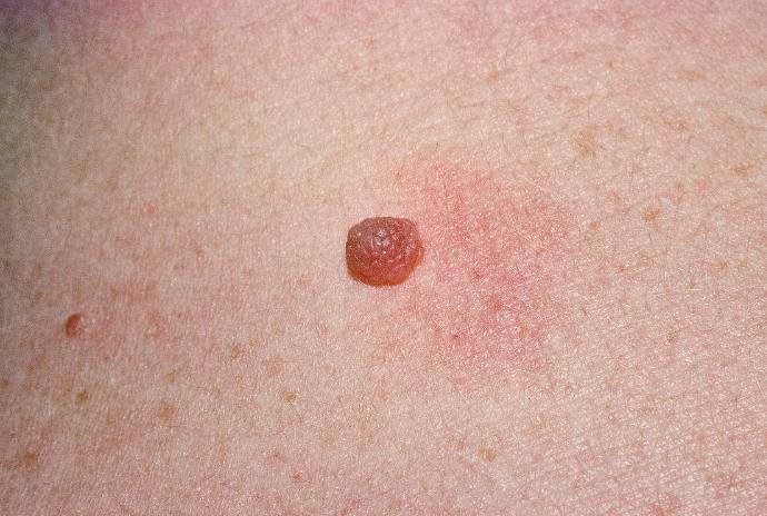 注意了身上长这5种痣特容易癌变,痣出现哪些变化是恶变的征兆