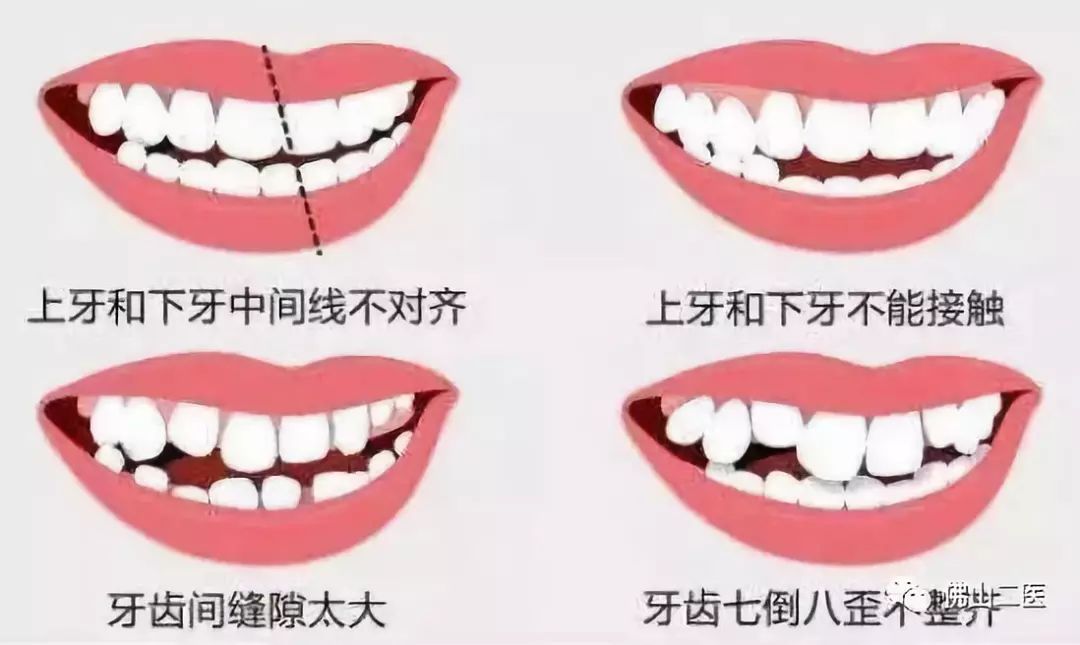 牙不齐不敢笑,牙不齐想整牙又太贵怎么办