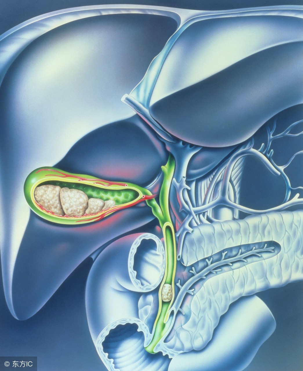 合理饮食习惯预防胆囊结石,饮食严格控制胆结石不长么