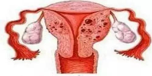 20岁子宫腺肌症能根治吗,子宫腺肌症能彻底根治吗