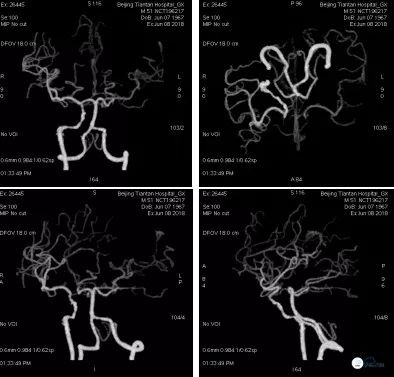 颈动脉闭塞介入治疗的风险,慢性动脉闭塞症病例