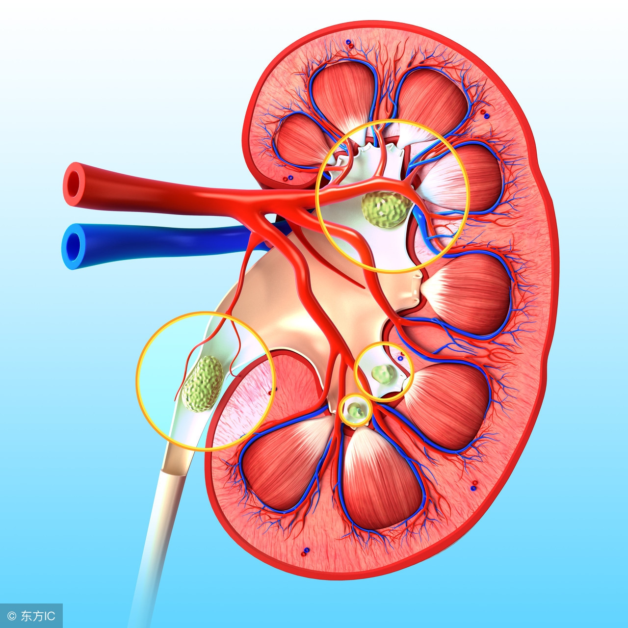 肾结石饮食要注意哪些食物不能吃,肾结石哪些食物不能吃要注意什么