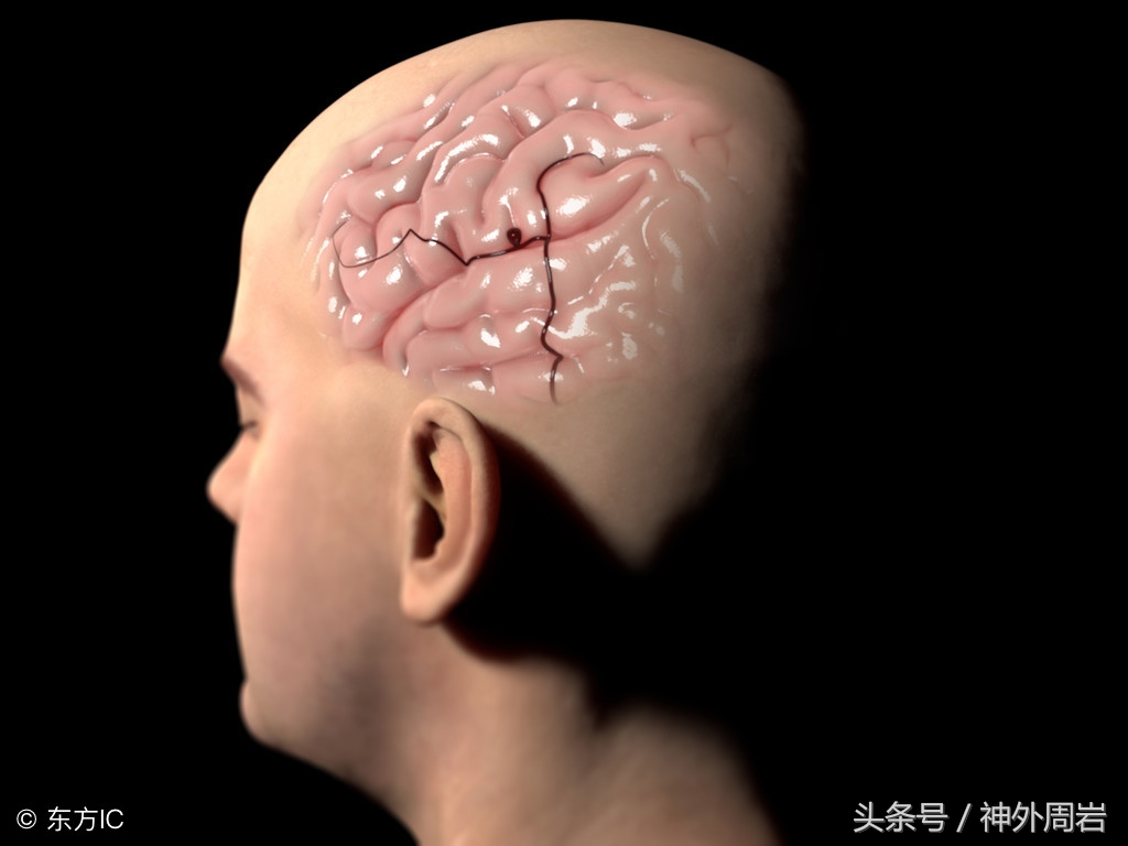 脑干海绵状血管瘤的亲身经历,海绵状脑血管瘤专家