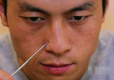 鼻子黑头小颗粒怎么去除,鼻子反复长黑头挤完都是坑