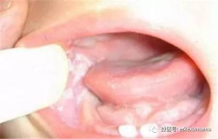 宝宝得鹅口疮是怎么引起的,宝宝得鹅口疮的快速治疗方法