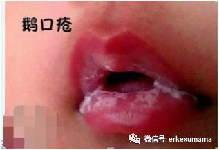 宝宝得鹅口疮是怎么引起的,宝宝得鹅口疮的快速治疗方法