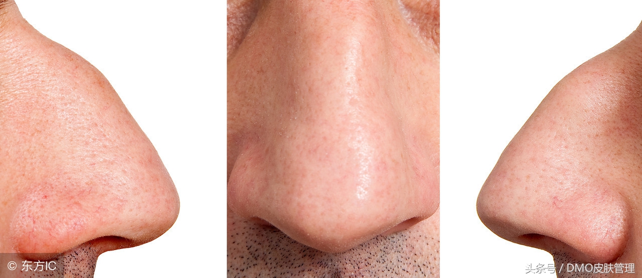 黑头密集怎么办,黑头病怎么治