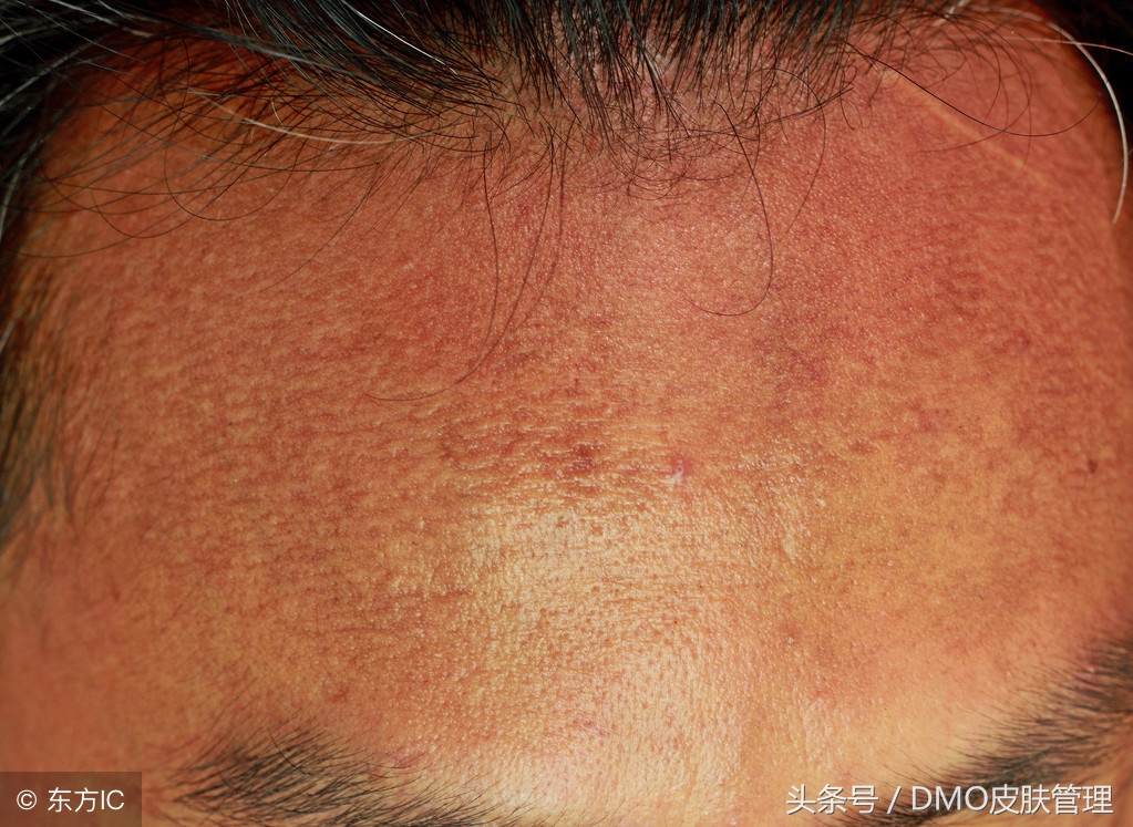 黑头密集怎么办,黑头病怎么治