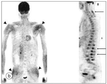 老年不明原因发热,老年人无症状发烧是怎么回事