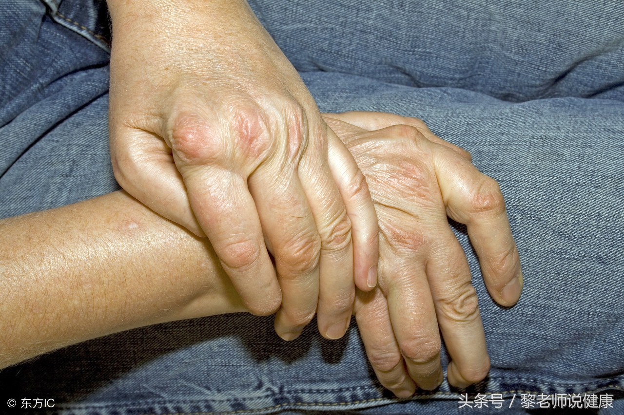 尿酸结晶用什么方法能消除,降尿酸溶解尿酸结晶需要多久