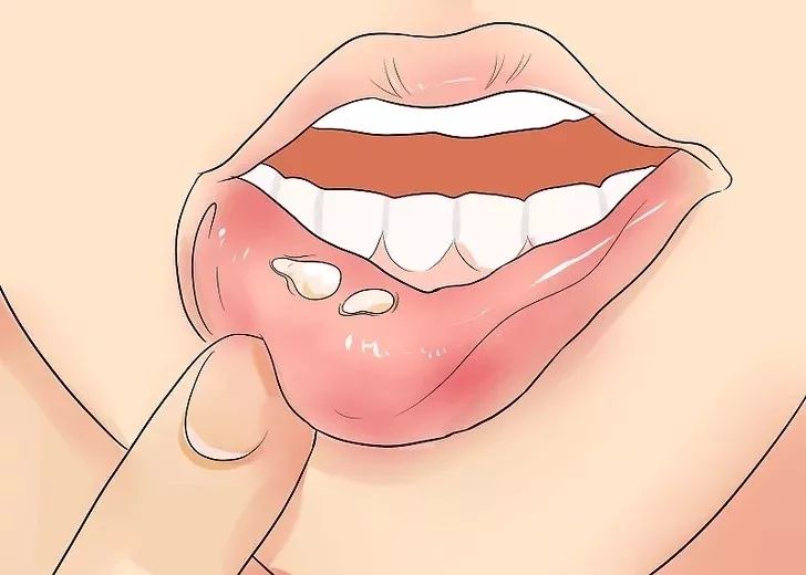 嘴巴上起泡快速消除小窍门,嘴巴上起泡了是怎么回事