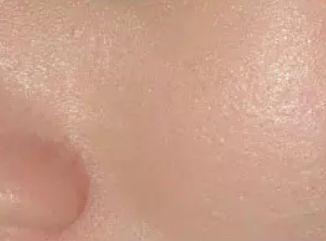 治疗毛孔粗大的护肤品,烟酰胺可以治疗毛孔粗大吗