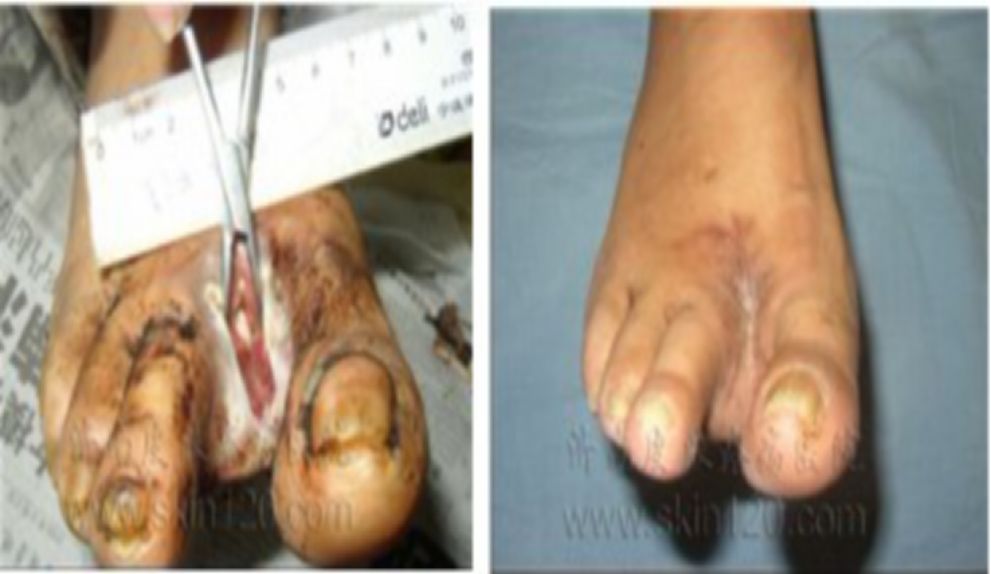 糖尿病下肢血管介入手术成功率,糖尿病下肢麻木中医辨证分析