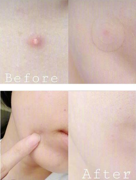 控油祛痘神器推荐,祛痘神器国货推荐