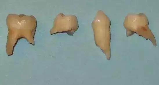 乳牙拔出后牙根却不完整,乳牙拔掉了新牙迟迟不出