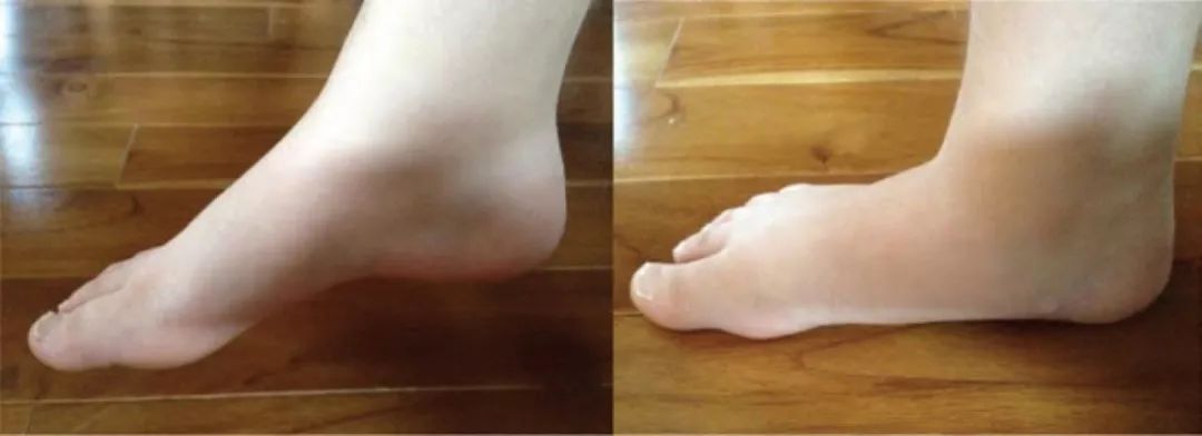 儿童扁平足矫正,儿童轻微扁平足还需要穿矫正鞋吗