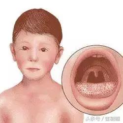 猩红热皮肤病怎么治,儿童猩红热症状及治疗方法