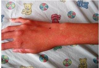 皮肤紫色瘀斑怎么快速恢复,瘀点瘀斑是哪个疾病的特点