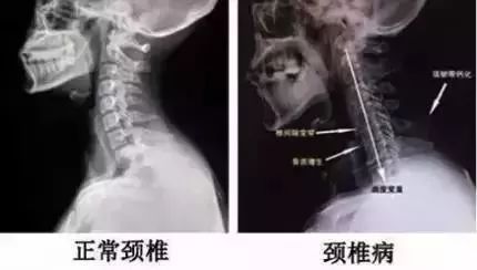 颈椎疼？脖子僵硬？睡觉用上它，颈椎病偏头痛全好了！