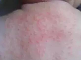 宝宝身上一大片的包是怎么回事,宝宝身上好多片包