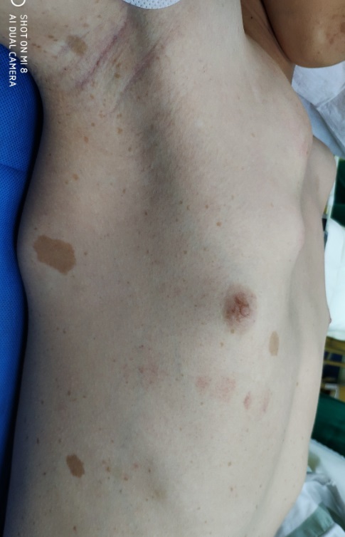 重度漏斗胸手术怎么做,胸廓畸形导致缺氧能做手术吗