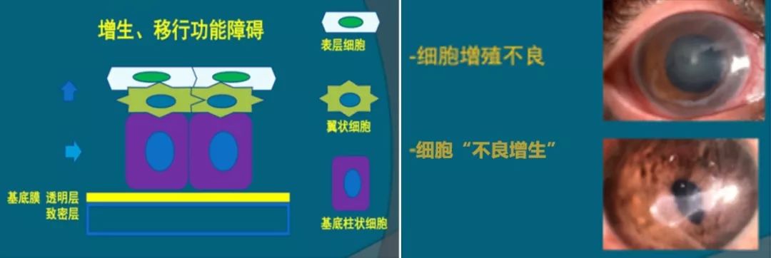 角膜上皮细胞损伤多久能恢复,治疗角膜上皮细胞损伤全国专家