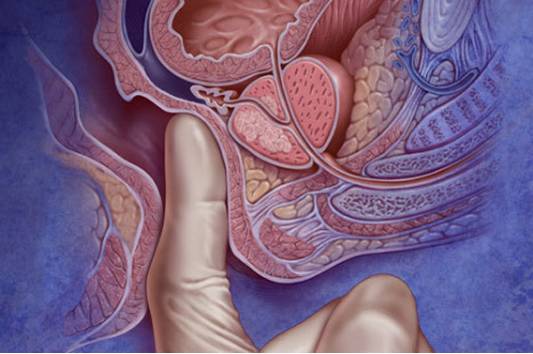 痔疮会引起直肠癌吗,直肠癌与痔疮的鉴别