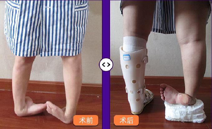 手足畸形矫正,手足畸形精准治疗