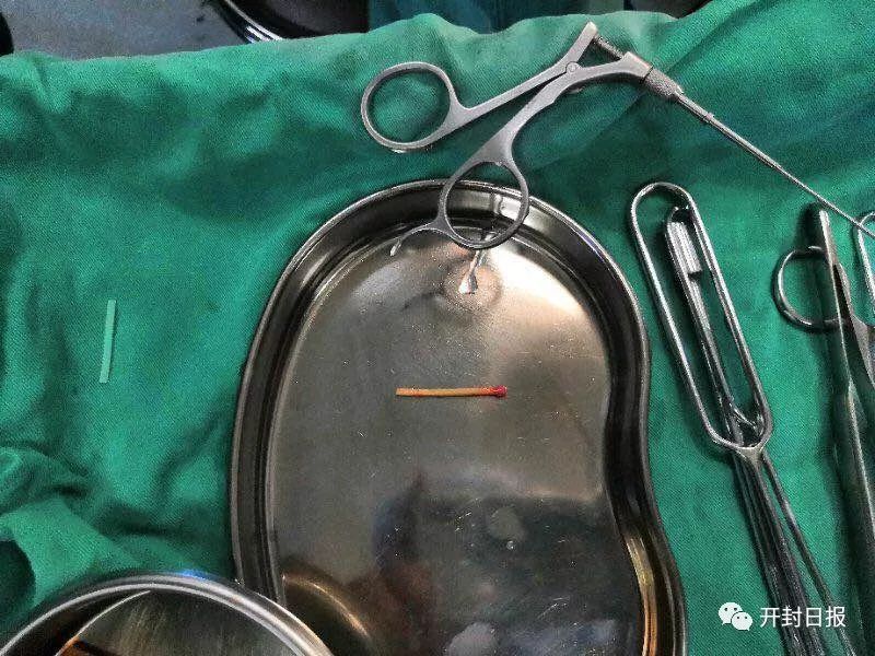 开封5岁女童身体异样，妇产医院紧急手术，取出一根火柴棒……