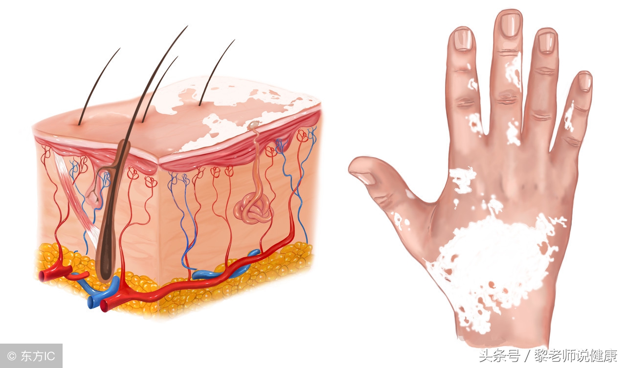 怎么治疗白癜风才能防止白斑复发,吃什么可以改善预防白癜风
