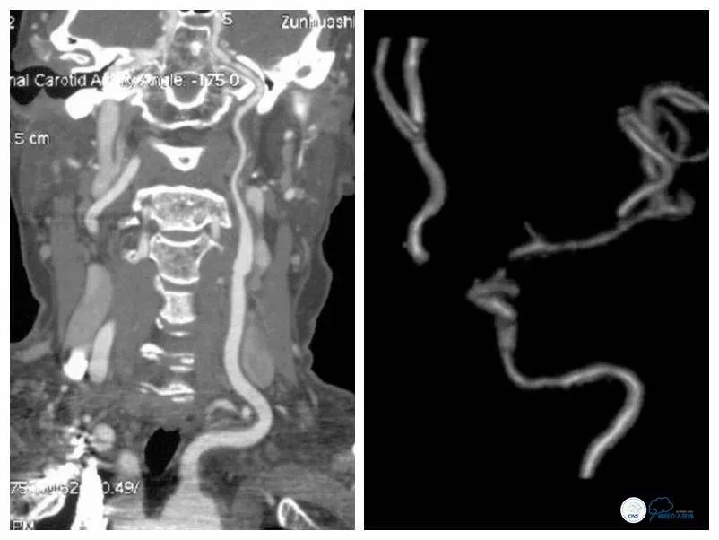 颈内动脉c5到c7段狭窄微创手术,天坛医院住院日记