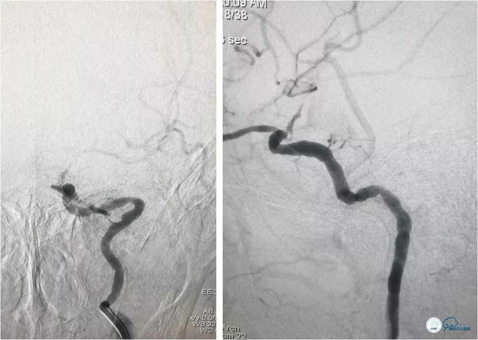 颈内动脉c5到c7段狭窄微创手术,天坛医院住院日记